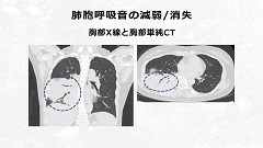 Dr.皿谷の肺音聴取道場(全10回)|第3回 正常呼吸音を聴く Dr.皿谷の肺音聴取道場(全10回)|第3回 正常呼吸音を聴く