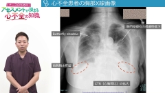 ナースのためのアセスメントが深まる心不全の知識|心不全患者のフィジカルアセスメントと心原性ショック