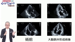 ナースのための心エコーレポートの読み方|治療前後のエコー動画の比較とEF（左室駆出率）