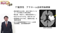 【資料・受講証明書付き】ナースが知っておくべき脳卒中治療と管理|【資料・受講証明書付き】ナースが知っておくべき脳卒中治療と管理