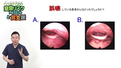 ナースのための窒息リスクアセスメントと食支援|誤嚥とは違う窒息のリスクと発生状況