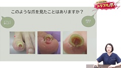 ナースのためのトラブル爪ケア|爪に起こるトラブル