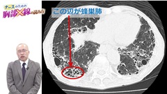 ナースのための胸部X線の読み方|疾患別　X線写真での見え方