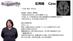 ナースのための高次脳機能障害ケア　病態と看護がつながる基礎知識|応用編case：脳梗塞患者のアセスメント