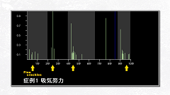 【受講証明書付き】Dr.皿谷の肺音聴取道場（全10回）|第7回　肺底部で聴こえる音