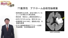 ナースが知っておくべき脳卒中治療と管理|脳梗塞の分類と急性期治療