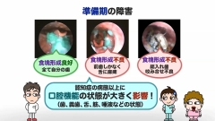 【受講証明書付き】Dr.野原のナルホド！摂食・嚥下障害マネジメント　～キュアからケアへ～（全13回）|第4回　助けて歯医者さん！　準備期の障害への食事支援