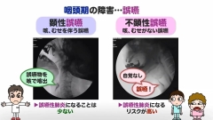 【受講証明書付き】Dr.野原のナルホド！摂食・嚥下障害マネジメント　～キュアからケアへ～（全13回）|第7回　食道？気管？運命の分かれ道！　咽頭期の障害への食事支援