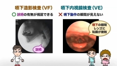 Dr.野原のナルホド！摂食・嚥下マネジメント　～キュアからケアへ～|【コラム１】頼れる武器、嚥下内視鏡を活用しよう