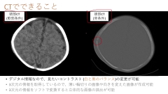 ナースのための頭部CTの見かた|画像診断の基礎知識と正常な頭部CT画像