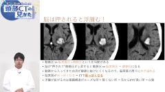 ナースのための頭部CTの見かた|脳出血と脳ヘルニアの症例画像