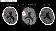 ナースのための頭部CTの見かた|脳梗塞・脳腫瘍の症例画像とまとめ