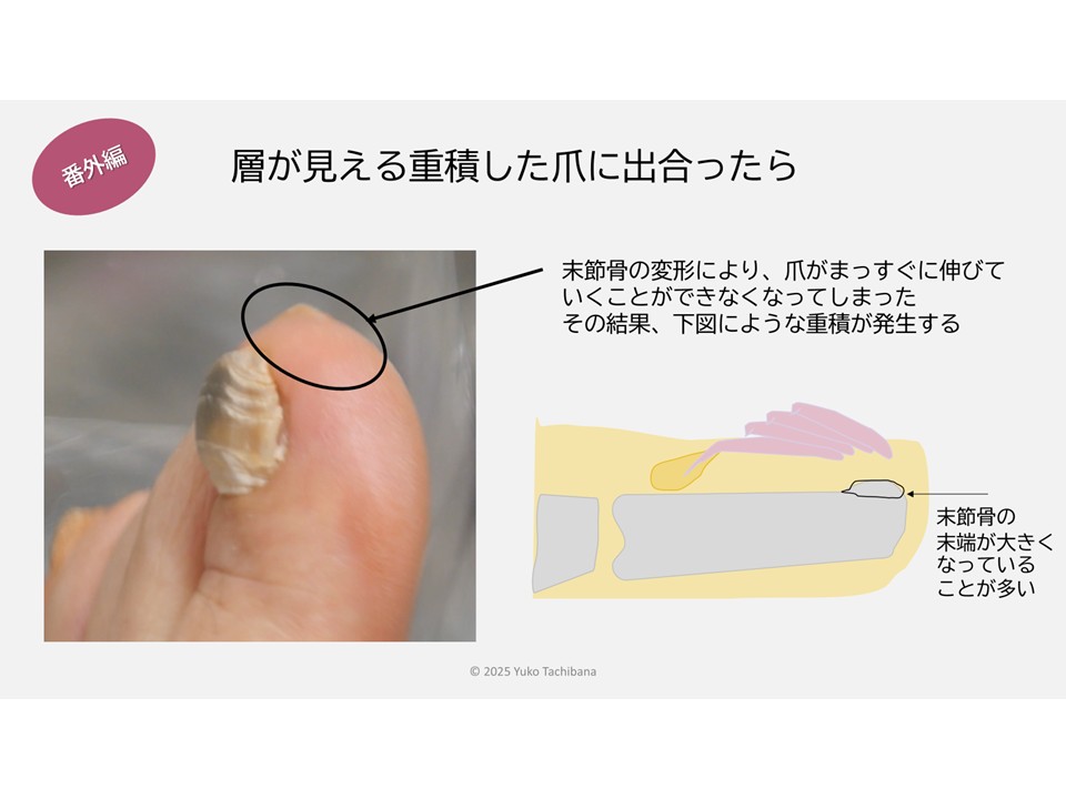 ナースのためのトラブル爪ケア