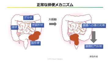 ナースのための排便コントロールのポイント