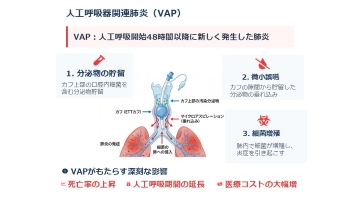 ナースのための人工呼吸ケア　人工呼吸管理の適応とグラフィックモニターの見かた