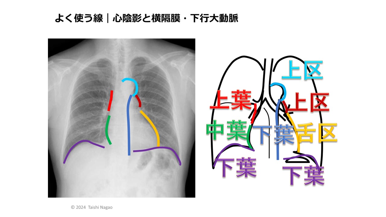 Dr長尾のナースのための胸部X線クイズ