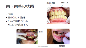 【実技動画付き】ナースのための口腔ケア