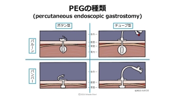 ナースのための経腸栄養