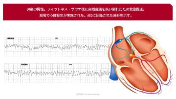 ナースのための心臓解剖から理解する心電図