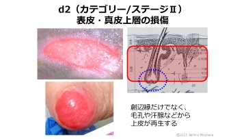 ナースのための褥瘡ケア