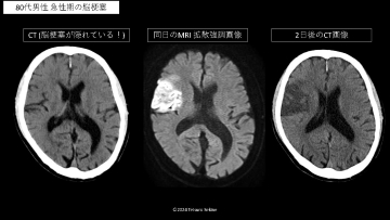 ナースのための頭部CTの見かた